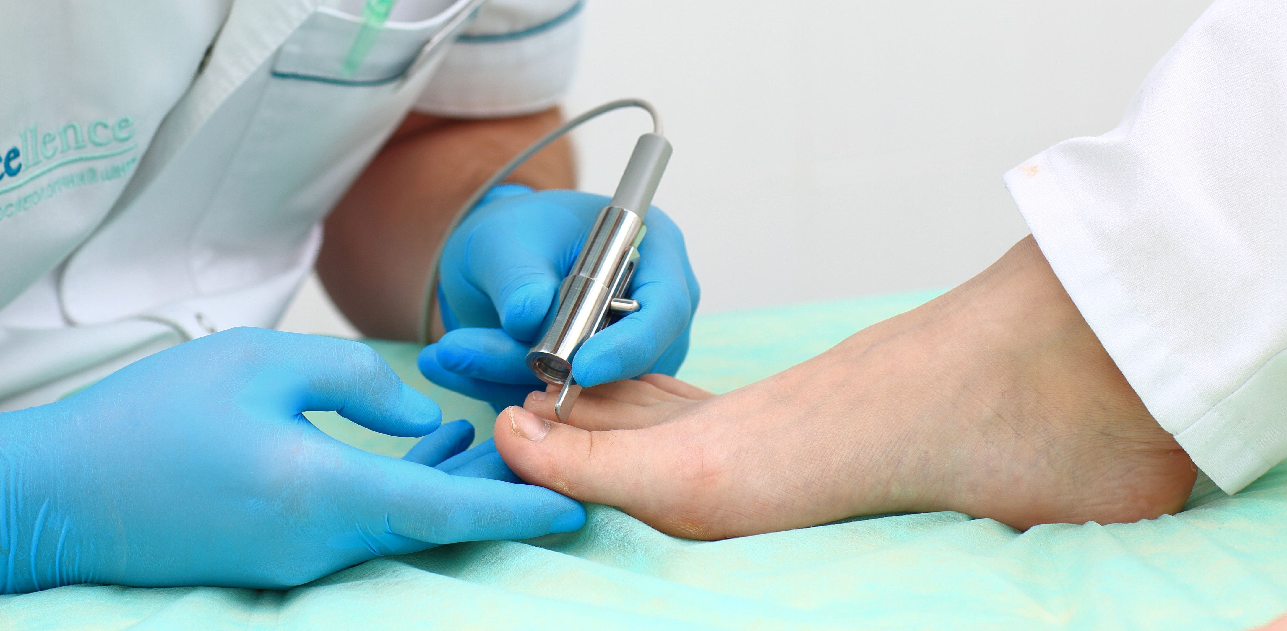 Лечение грибка ногтей (онихомикоз) лазером