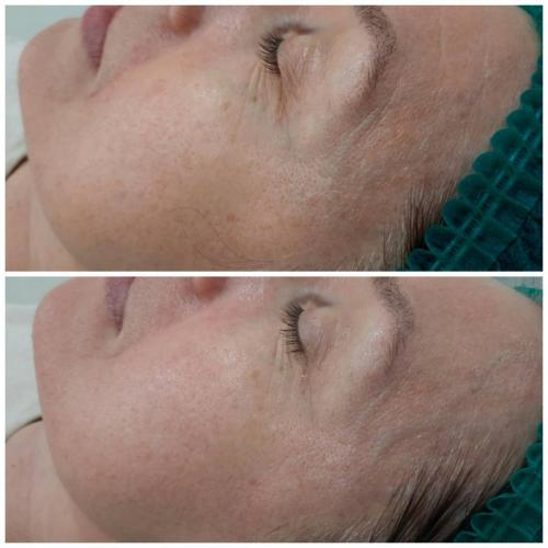 Пилинг для лица Skin Recovery — Доценко Лилия Григорьевна