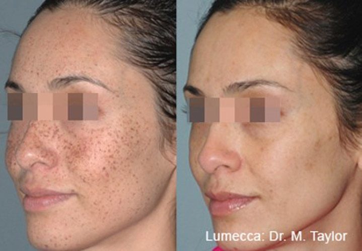 Удаление пигментации на лице и теле с помощью lumecca ipl