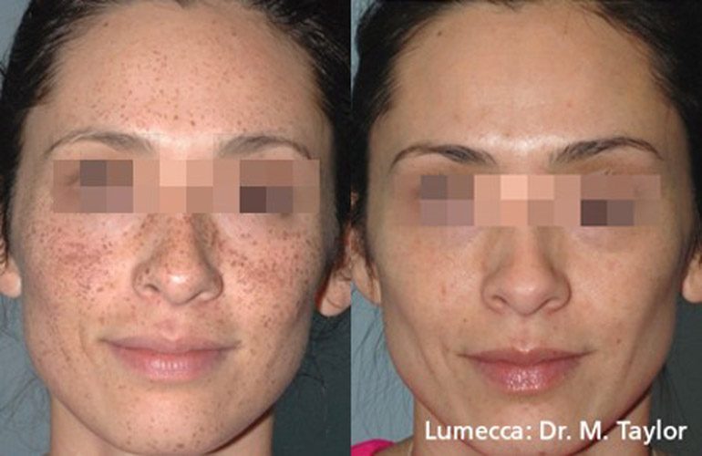 Удаление пигментации на лице и теле с помощью lumecca ipl